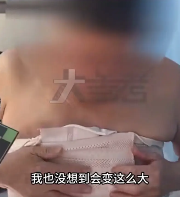 男性乳房發育症｜男子食瓜子致胸部升級？醫生拆解成因：原來與1種激素有關