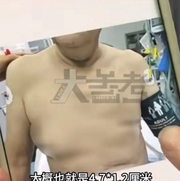 男性乳房發育症｜男子食瓜子致胸部升級？醫生拆解成因：原來與1種激素有關