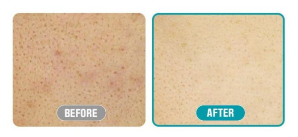 韓國護膚品推薦｜銷量排名3位. Mediheal Madecassoside Blemish Pad 積雪草修護棉片