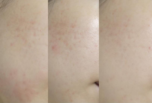 韓國護膚品推薦｜銷量排名9位. Bring Green Zinc Teca Blemish Serum 修護精華