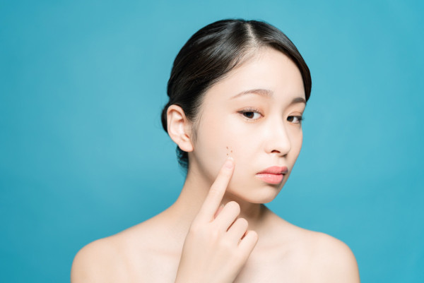 痣面相 點痣與脫墨能改運嗎？