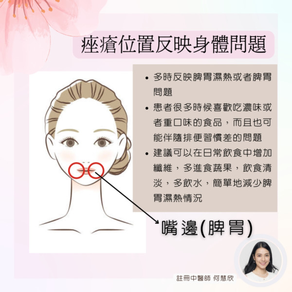 暗瘡4位置成因