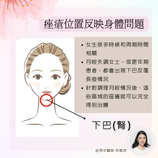 暗瘡4位置成因