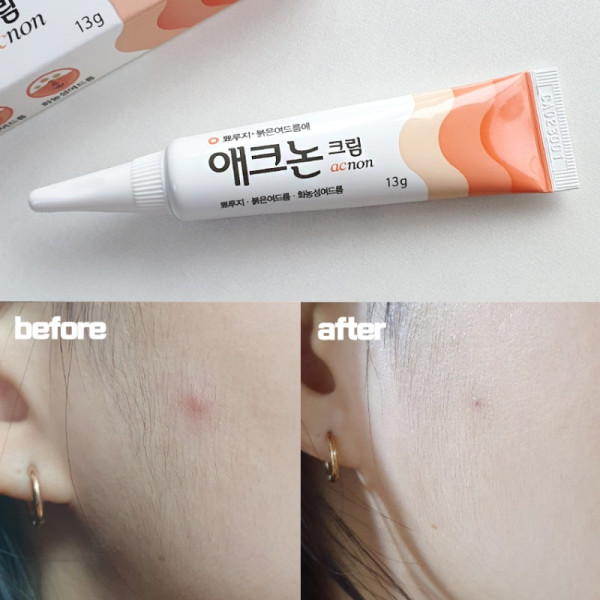 韓國藥局必買｜3. Acnon Cream抗炎殺菌袪痘膏暗瘡膏 