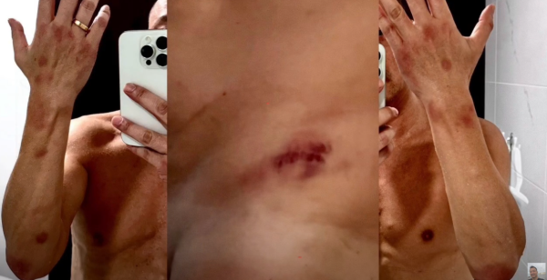 王喜自爆兩度懷疑被迷姦傷勢照片曝光 憶述下半身難以活動：我應該失禁