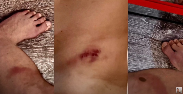 王喜自爆兩度懷疑被迷姦傷勢照片曝光 憶述下半身難以活動：我應該失禁