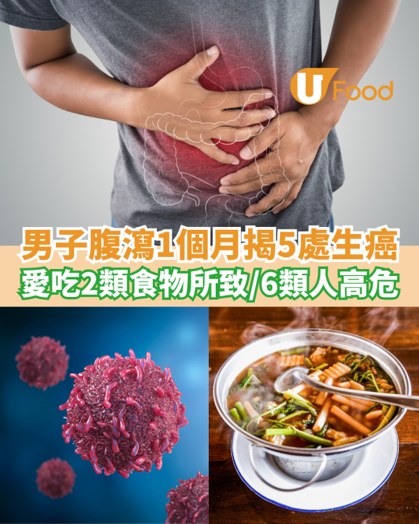 男子腹瀉1個月揭5處生癌 愛吃2類食物所致！6類人高危