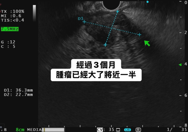 60歲男不煙不酒無不適竟已患胰臟癌！醫生：8成病患均有1症狀／3個月腫瘤大一半