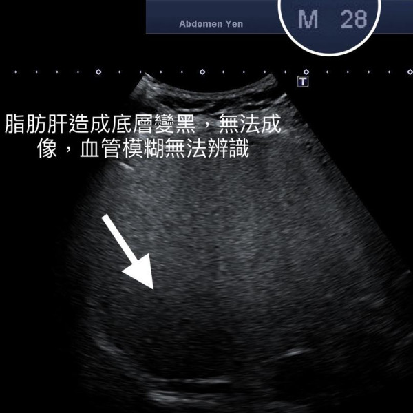 長壽養生祕訣｜100歲老翁肝臟報告比28歲健康！全靠3招三餐食魚