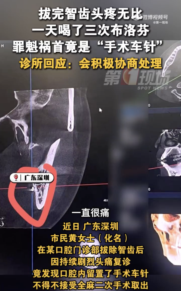 深圳福田拔智齒致頭部劇痛多日 覆診驚見口腔殘留手術針 
