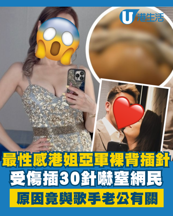 最性感港姐亞軍裸背驚插30針嚇窒網民 自揭受傷原因竟與歌手老公有關