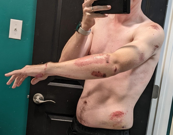 骨科醫生提醒 潮玩電動單車一原因使事故程度激增 【附8大安全建議】