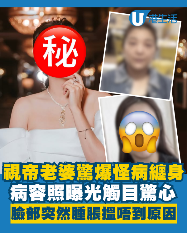 視帝老婆驚爆怪病纏身臉部突然腫脹 發炎病容照觸目驚心：搵唔到原因