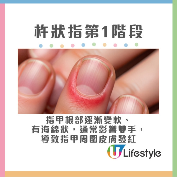 杵狀指分3階段變化
