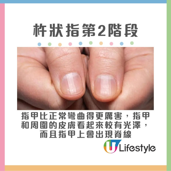杵狀指分3階段變化