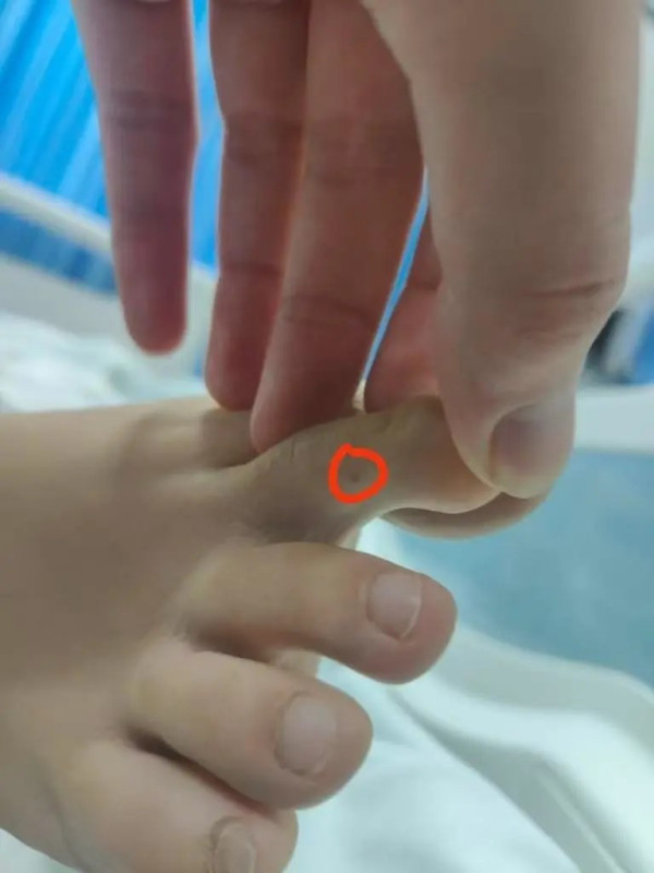 27歲女三亞旅遊遭毒蛇咬翌日亡 家屬質疑醫院延誤治療錯失黃金時間 附應急教學 