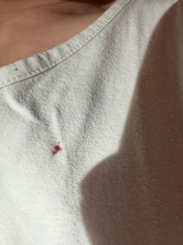 入住酒店疑被床蝨咬至流血!郭子豪現紅腫傷口發文求救 酒店專家教3點防範!