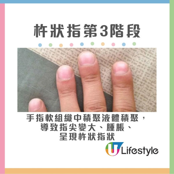 杵狀指分3階段變化