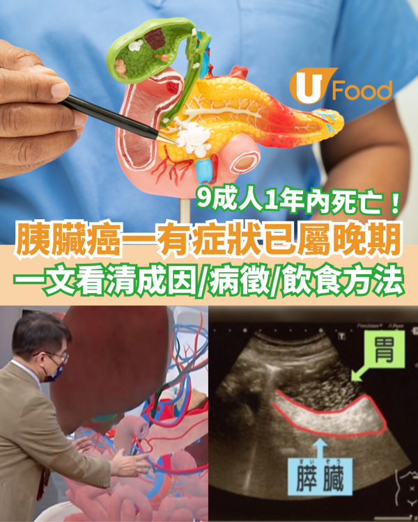 胰臟癌一有症狀已屬晚期9成人1年內死亡 一文看清胰臟癌成因／病徵／飲食方法（附食譜）