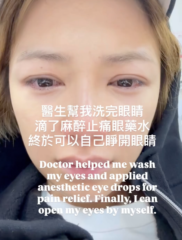 37歲女星敷日本面膜險盲！雙眼強烈刺痛 凌晨掛急症求醫 