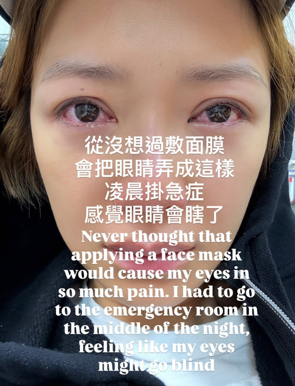 37歲女星敷日本面膜險盲！雙眼強烈刺痛 凌晨掛急症求醫 