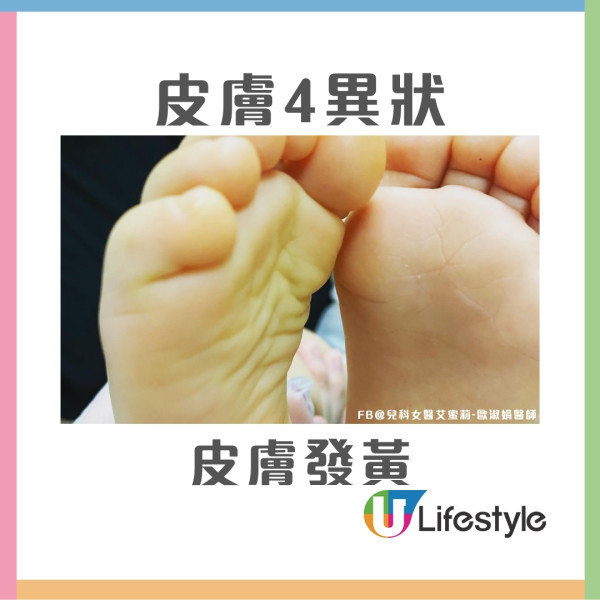 50歲女雙腿皮膚痕癢2個月體檢揭患肝癌 醫生籲皮膚4異狀要小心！