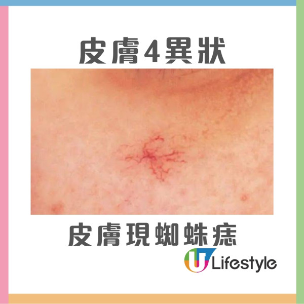 50歲女雙腿皮膚痕癢2個月體檢揭患肝癌 醫生籲皮膚4異狀要小心！