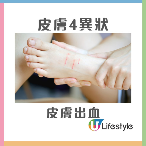 50歲女雙腿皮膚痕癢2個月體檢揭患肝癌 醫生籲皮膚4異狀要小心！