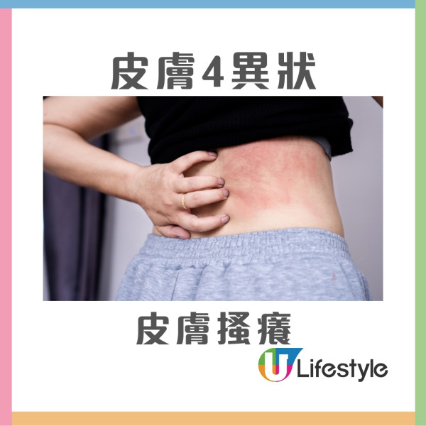 50歲女雙腿皮膚痕癢2個月體檢揭患肝癌 醫生籲皮膚4異狀要小心！