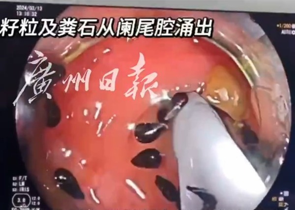 30多歲男食西瓜不吐籽致患盲腸炎！幾十粒籽積在盲腸需手術取出