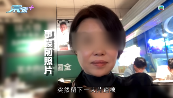 激光去斑後現勁多黃黑斑，節目截圖，圖片來源︰東張西望。