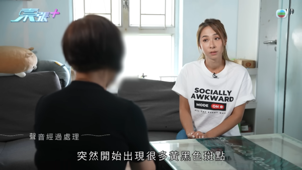 激光去斑後現勁多黃黑斑，節目截圖，圖片來源︰東張西望。