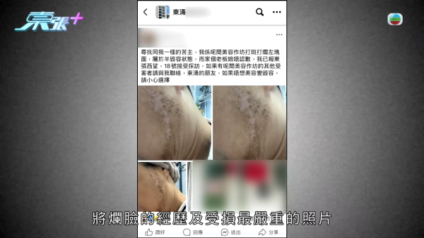 激光去斑後現勁多黃黑斑，節目截圖，圖片來源︰東張西望。