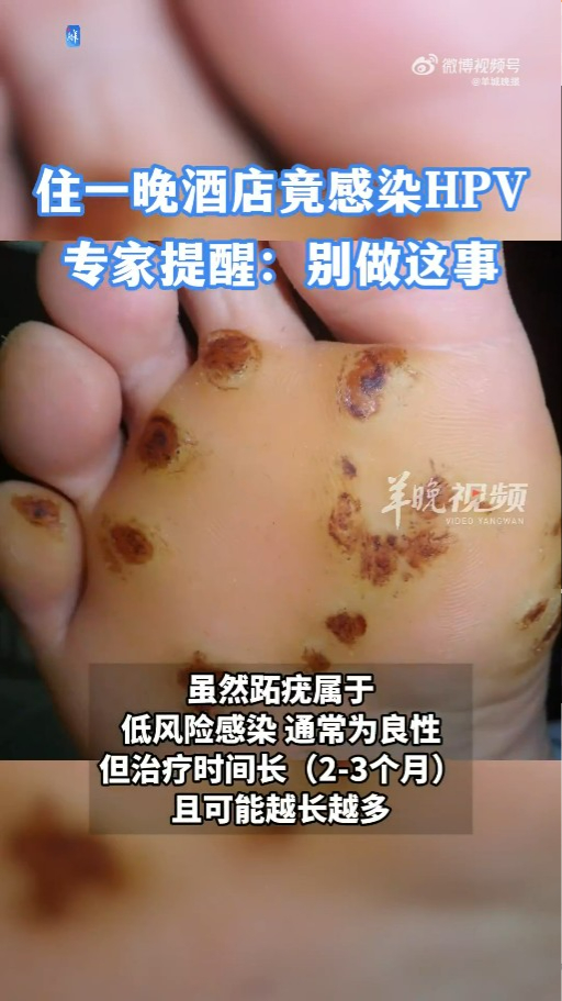 內地連續兩名兒童玩水後感染「食腦蟲」死亡！專家指一旦感染致死率達98% 