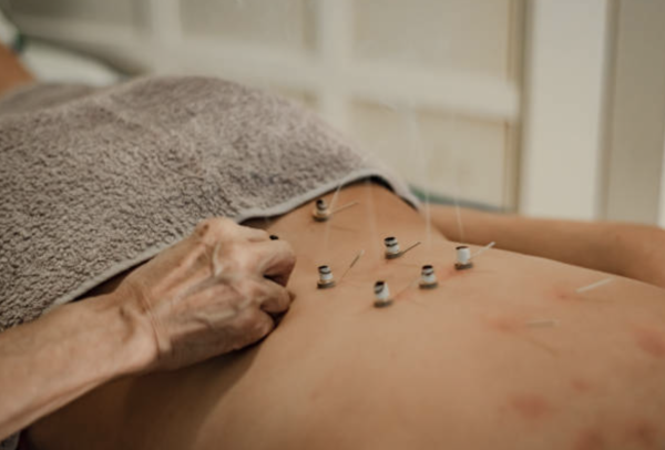 艾灸 圖片來源:iStock