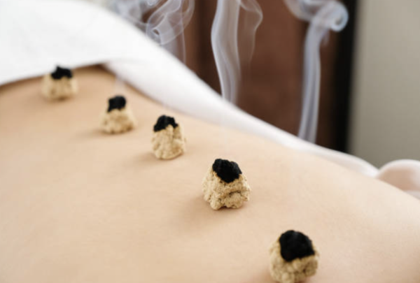 艾灸 圖片來源:iStock