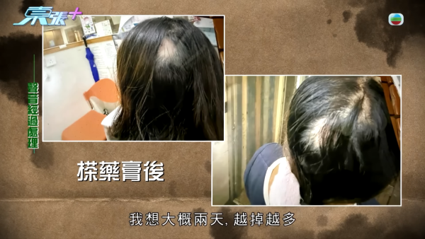 貪靚港女醫「鬼剃頭」打針生髮慘變禿頭 怒控診所不負責任：我36歲你搞到我似66歲！