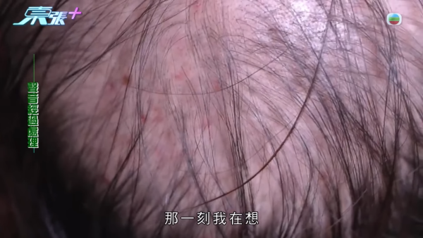 貪靚港女醫「鬼剃頭」打針生髮慘變禿頭 怒控診所不負責任：我36歲你搞到我似66歲！