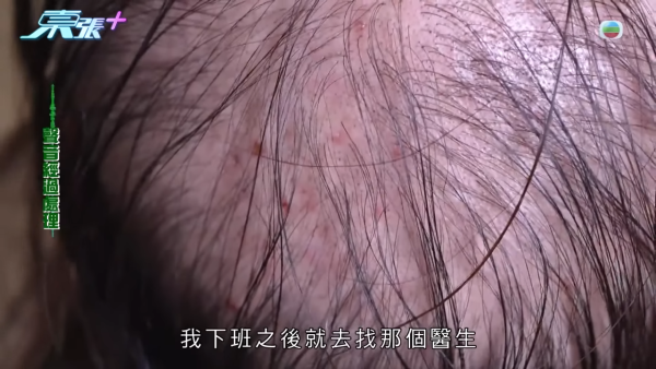 貪靚港女醫「鬼剃頭」打針生髮慘變禿頭 怒控診所不負責任：我36歲你搞到我似66歲！