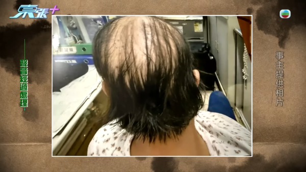 貪靚港女醫「鬼剃頭」打針生髮慘變禿頭 怒控診所不負責任：我36歲你搞到我似66歲！