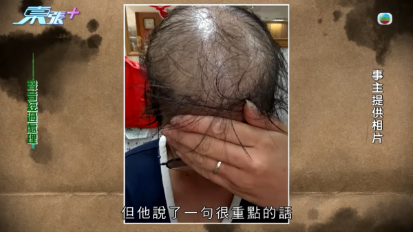 貪靚港女醫「鬼剃頭」打針生髮慘變禿頭 怒控診所不負責任：我36歲你搞到我似66歲！