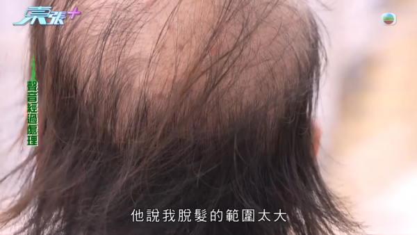 貪靚港女醫「鬼剃頭」打針生髮慘變禿頭 怒控診所不負責任：我36歲你搞到我似66歲！