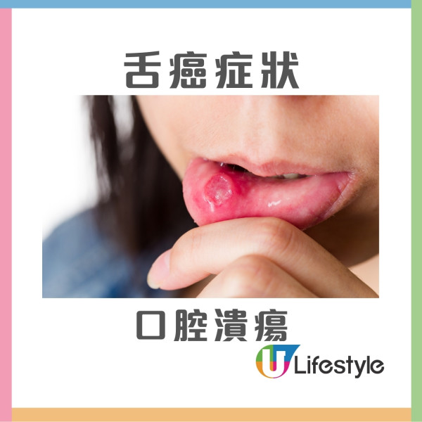 50歲男長期口臭誤以為扁桃腺結石 求醫揭患舌根癌二期 醫生︰4異味要留意！