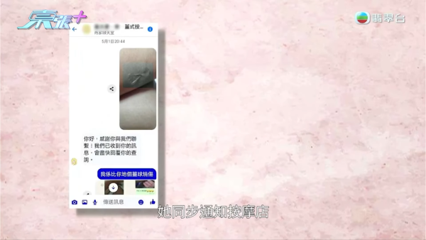 港媽「薑球按摩」慘變二級燒傷，節目截圖，圖片來源︰東張西望。