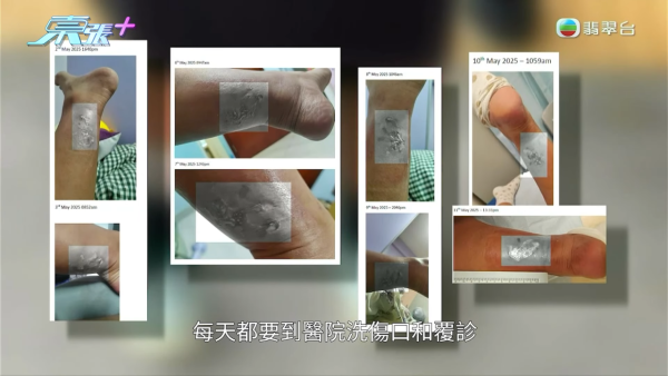 港媽「薑球按摩」慘變二級燒傷，節目截圖，圖片來源︰東張西望。