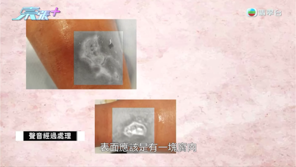 港媽「薑球按摩」慘變二級燒傷，節目截圖，圖片來源︰東張西望。