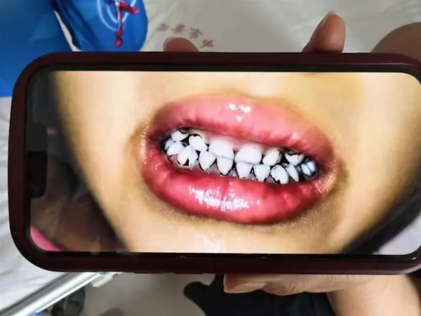 甘肅逾200名幼童集體中鉛毒 官稱：食品添加彩繪顏料 網傳工業污染疑雲