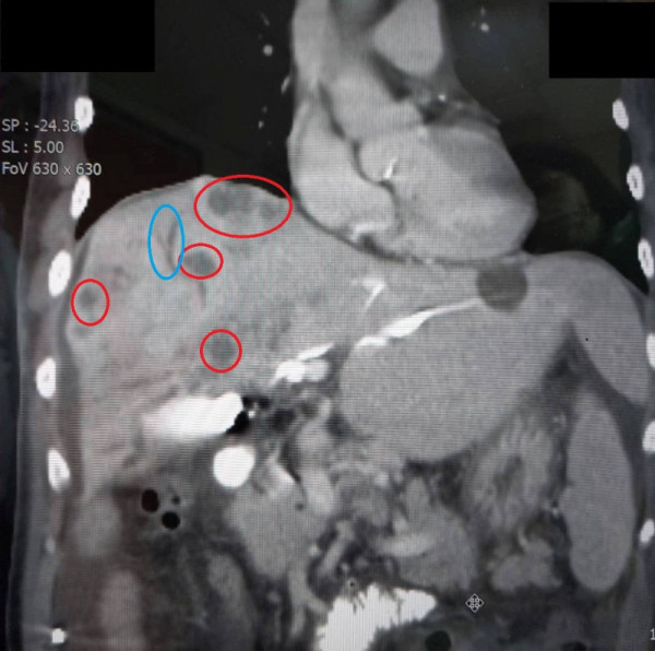 66歲男皮膚發黃驚患膽管癌末期 醫生︰初期症狀不明顯易被忽略延醫
