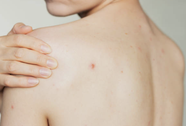 背部暗瘡 圖片來源：iStock
