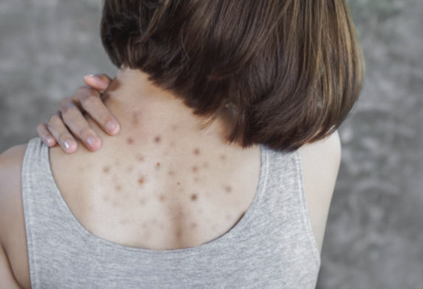 背部暗瘡 圖片來源：iStock